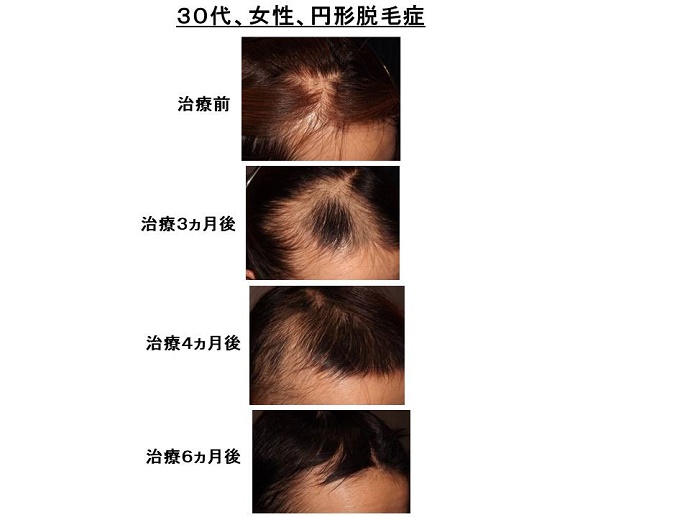 円形脱毛症　病院""